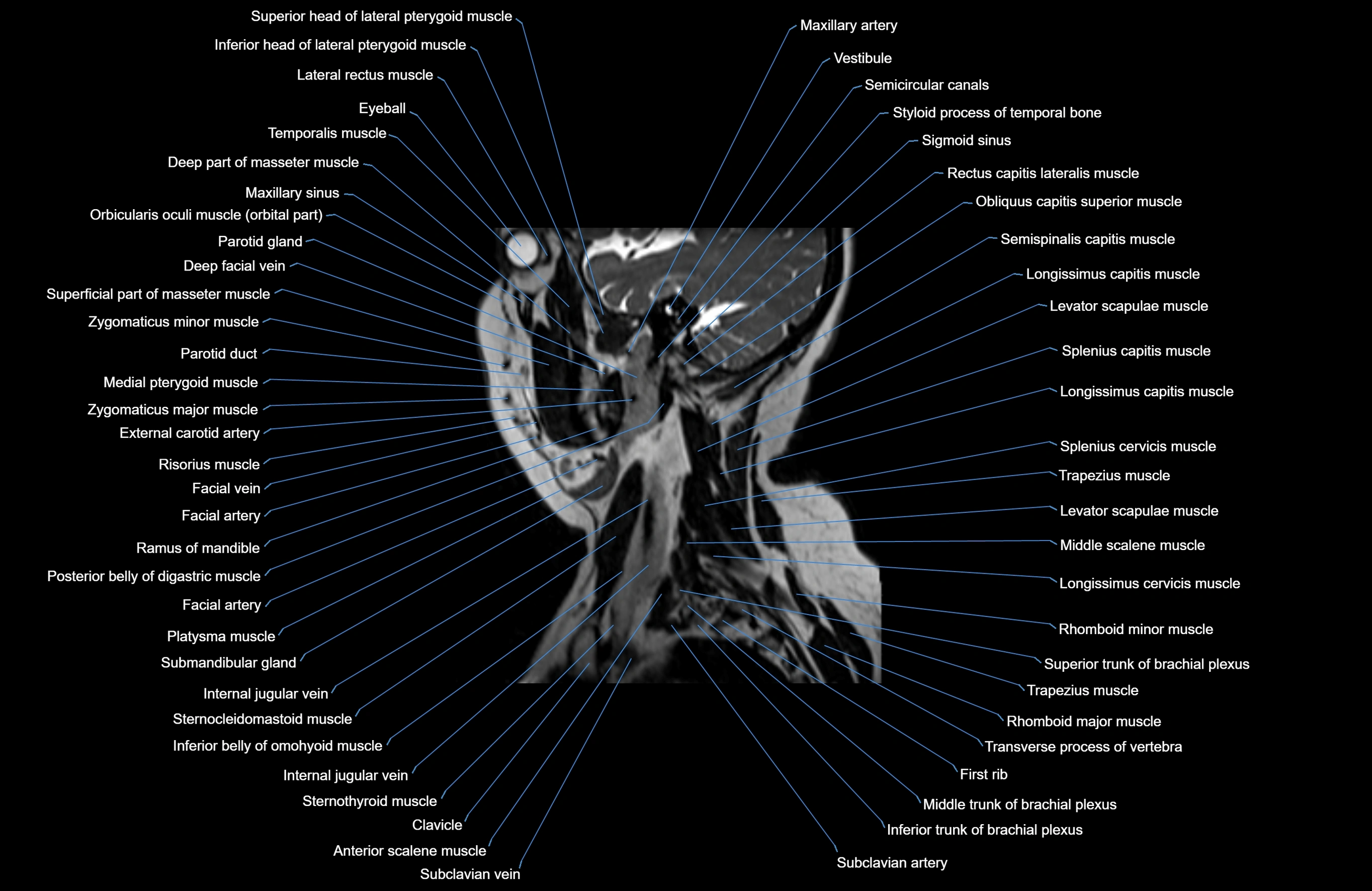 Neck MRI sagittal cross sectional anatomy 3D 1mm 3T radiology  image-img-00001-00025.webp